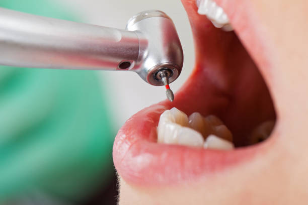 Best Emergency Dental Filling Replacement  in Winter Beach, FL